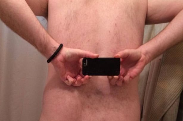Painful: The man took to Reddit to show off his unusual backside 