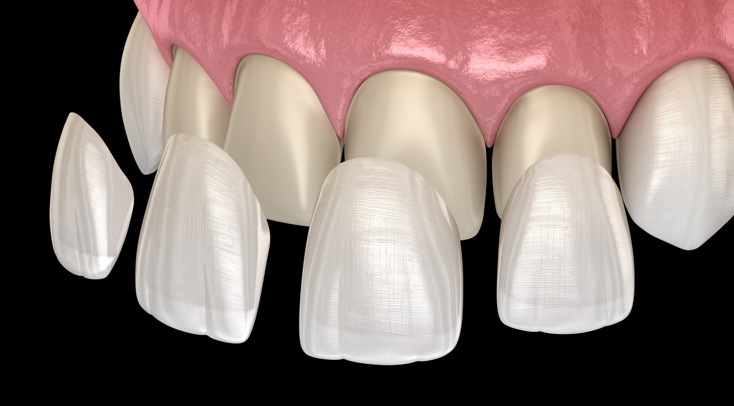 Do Veneers Hurt? A Step-by-Step Guide to the Painless Procedure