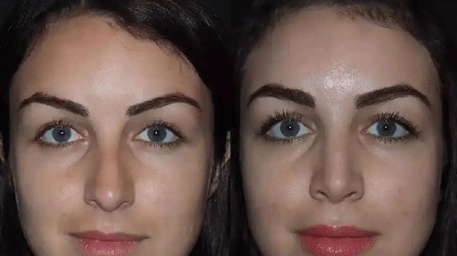 Best Rhinoplasty Surgeon in Dubai for Improved Facial Proportions