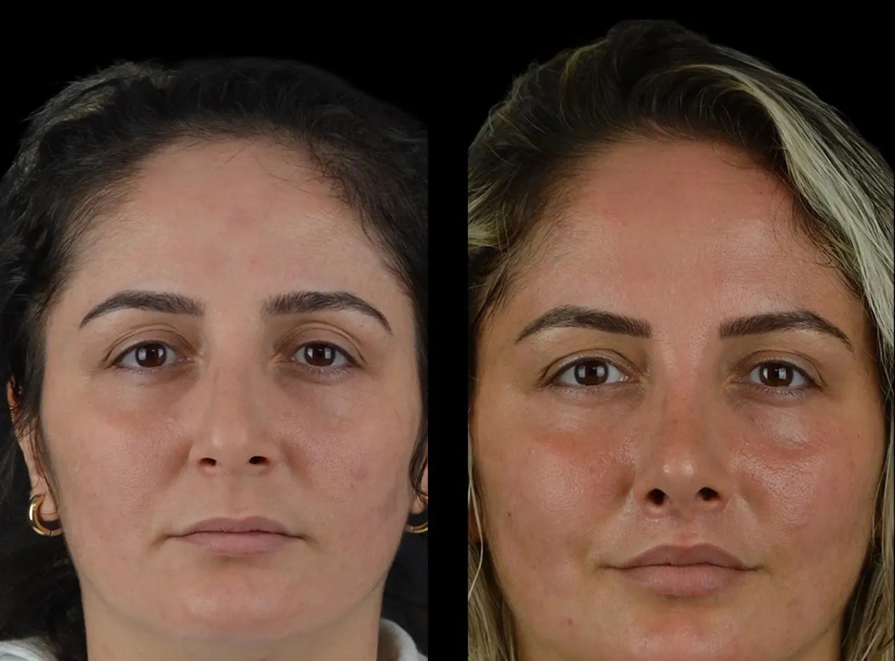 Cheek Fillers Aftercare Guide by Best Plastic Surgeons in Dubai