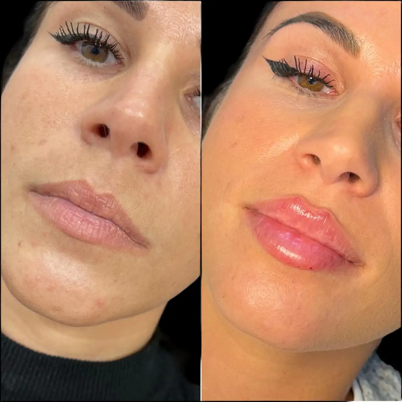 Professional Dermal Fillers by the Best Plastic Surgeons in dubai