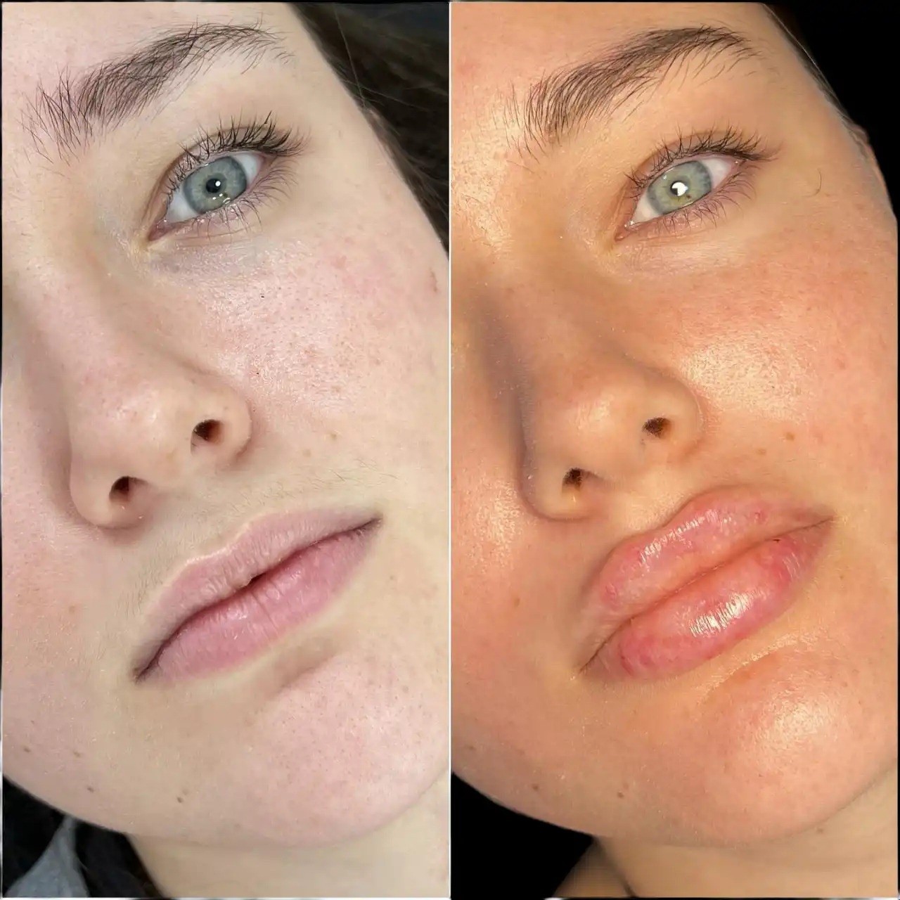 Understanding Combination Best Plastic Surgeons in Dubai Treatment Planning with Fillers